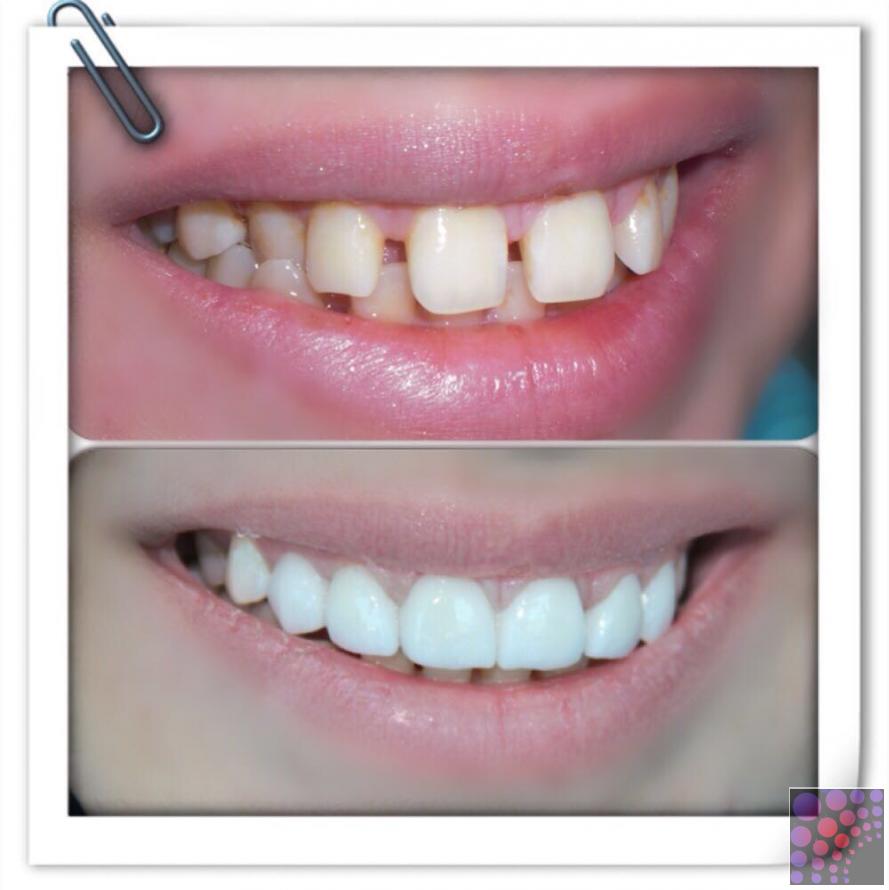 Best veneer quality in uae, Abu Dhabi, UAE