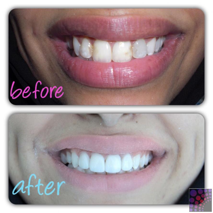 Best veneer quality in uae, Abu Dhabi, UAE