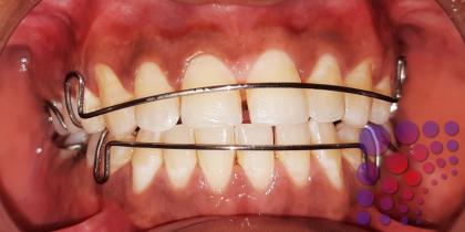 تركيب تقويم الأسنان الداخلي