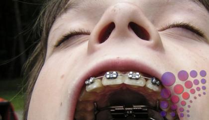 تركيب تقويم الأسنان الداخلي