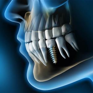 احدث الاجهزه لزراعه الاسنان في الشارقه