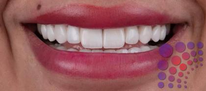 هل اسنان الارنب من علامات الجمال؟