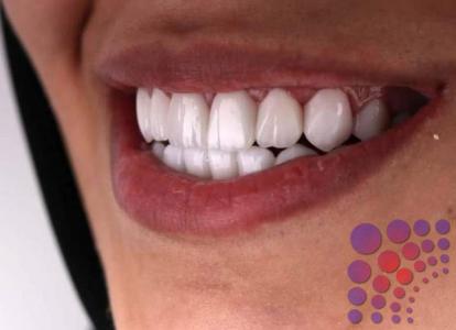 هل يتغير لون اسنان السيراميك؟