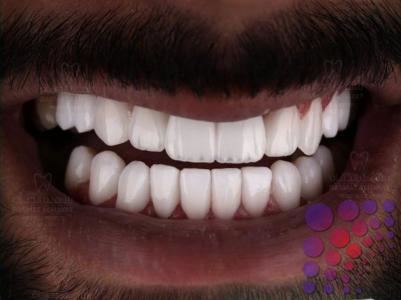علاج عصب الاسنان في ابوظبي