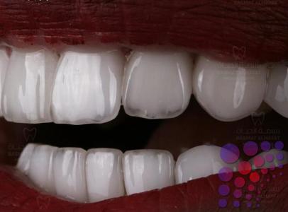 هل يتغير لون اسنان السيراميك؟