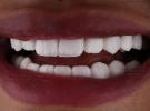 علاج عصب الاسنان في ابوظبي